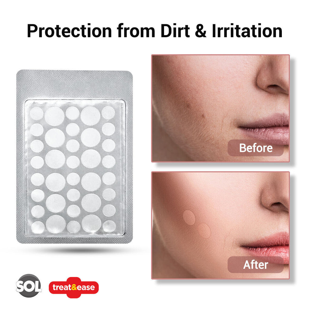 Cold Sore Patches | Acne Spot Pimple Hydrocolloid Breathable | 72 Pack